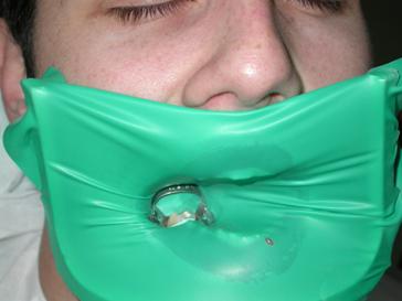 Tedavi edilecek alt büyük azı dişine rubber dam takılmış durumda artık hastanın aletleri yutması , kullanılan ilaçların ağza dökülmesi gibi bir risk söz konusu değil 