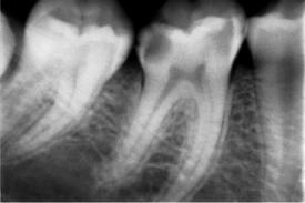 Diş çürüğü nedeniyle Pulpası (siniri) iltihaplanan bir dişin röntgendeki görünümü  
