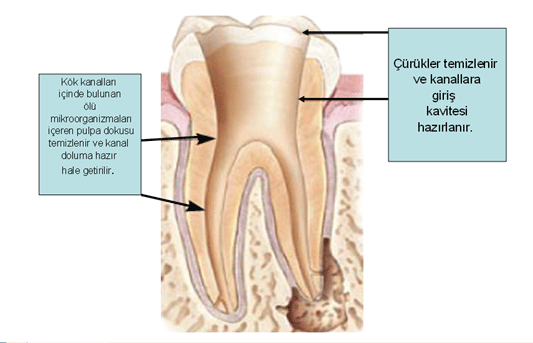 Diş siniri’nin kanal aletleriyle uzaklaştırılarak kök kanallarının temizlenmesi