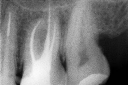 Başarılı bir kanal tedavisinin röntgen görüntüsü