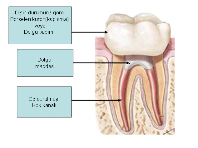 Kanal tedavisi gören dişler nasıl restore edilir?