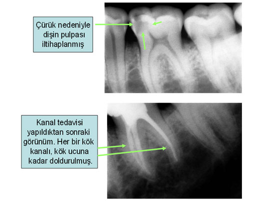 Kanal tedavisi gören bir dişin röntgendeki görünümü nasıldır?
