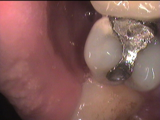Kötü yapılmış  diş tedavileri ( Dolgu ve kaplamalar)