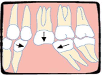 Daha önce çektirdiğim dişin yerine, yeni bir diş yapılmayacak olursa sakıncalı olur mu?