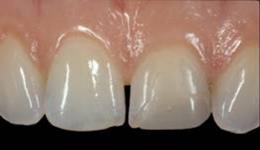 Sol üst orta kesici dişte kırık dolgu maddesiyle restore edilmiş yetersiz estetik