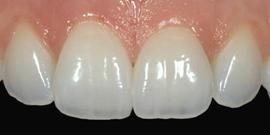 Ön orta kesici iki dişe porselen laminateler yapıştırıldıktan sonraki görünüm