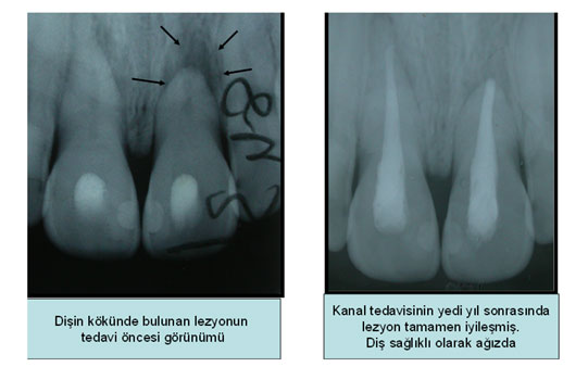 Lezyonlu dişler kanal tedavisi ile iyileşebilir mi?