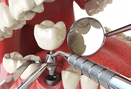 Dental İmplant ve Çene Cerrahisi